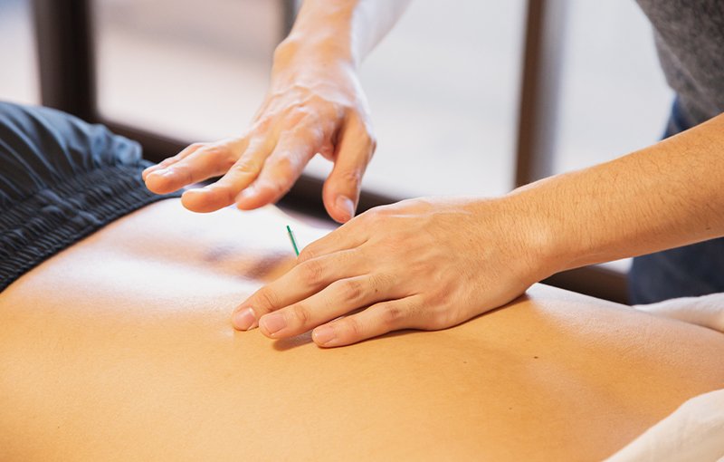 An image of a therapist placing an acupuncture needle in the back of a client
