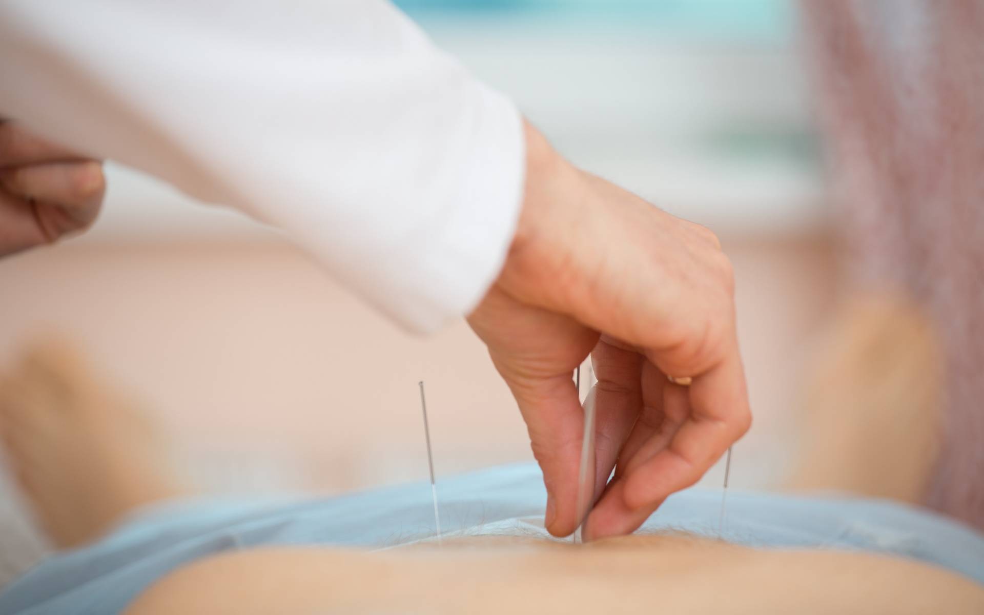 An image of a hand placing needles on the back of a patient during an acupuncture treatment.