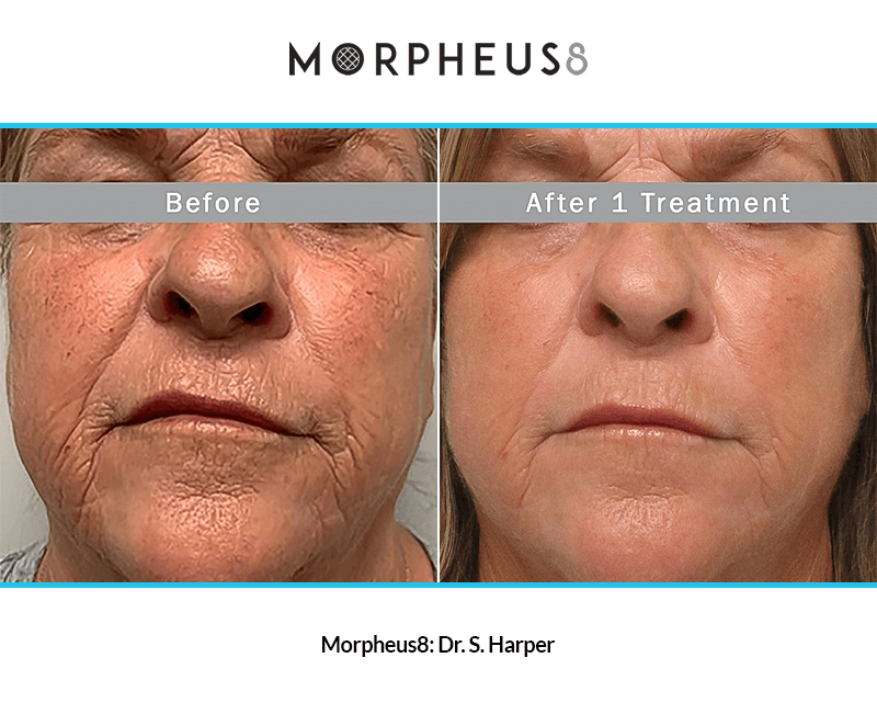 A collage of results after Morpheus8