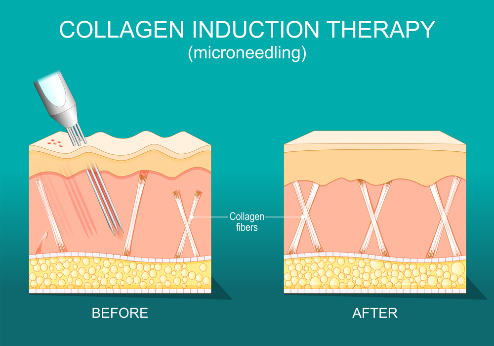 Microneedling