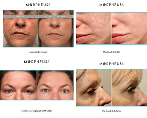 Before & after Morpheus8 skin treatment showing improved skin texture and reduced wrinkles.