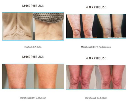 Morpheus8 treatment