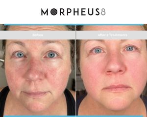 DM Treatments - Morpheus8 Calgary