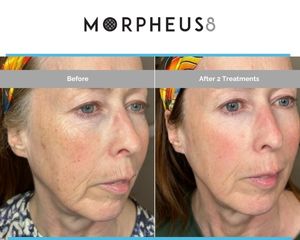 Morpheus8 Before After
