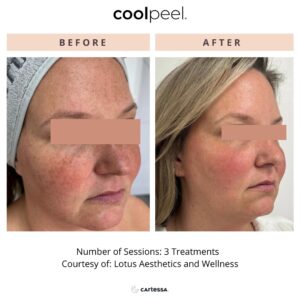 CoolPeel Before & After Image