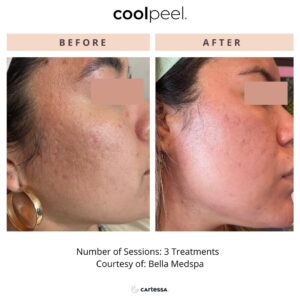 CoolPeel Before & After Image