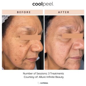 CoolPeel Before & After Image