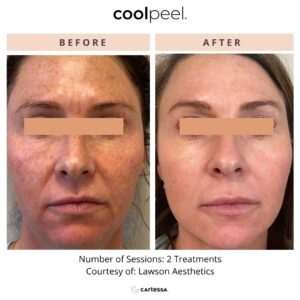 CoolPeel Before & After Image