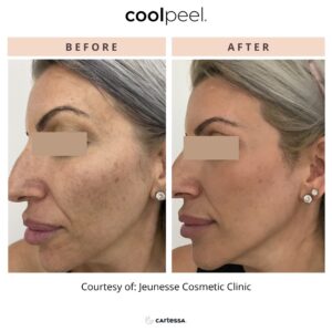 CoolPeel Before & After Image