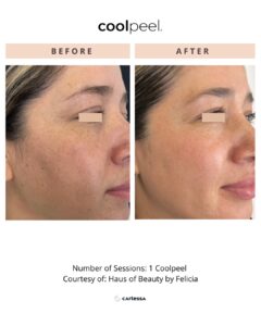 CoolPeel and Tetra BAs Nuvue 20 1080 x 1350 px - CoolPeel Template