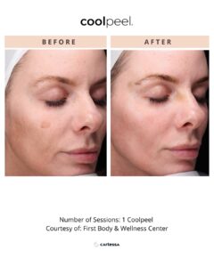 NEW CoolPeel and Tetra BAs Nuvue 20 1080 x 1350 px - CoolPeel Template