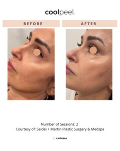 NEW CoolPeel and Tetra BAs Nuvue 20 1080 x 1350 px - CoolPeel Template