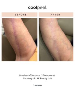 Cool Peel