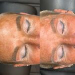 5 treatments saline removal Results after 5 Saline Tattoo Removal Sessions