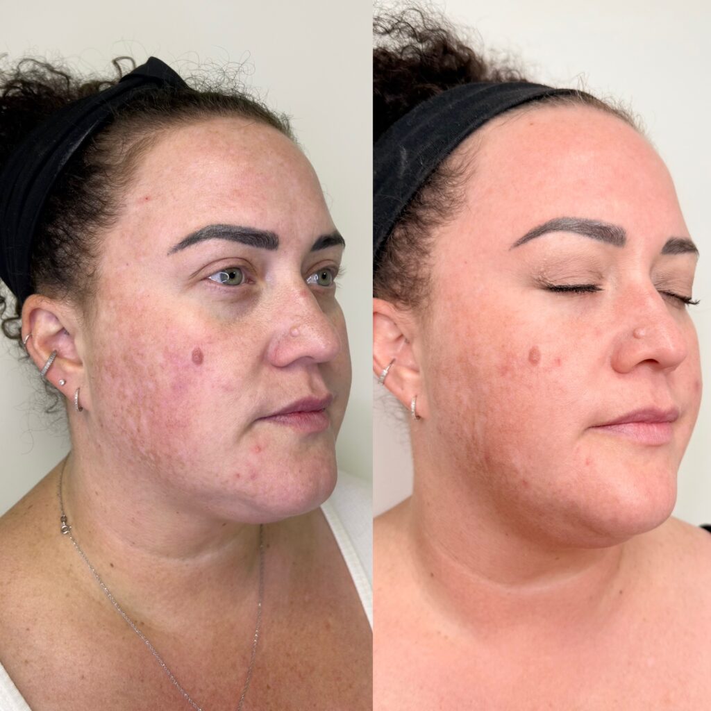 Lumecca after 1 treatment - D&M Treatments