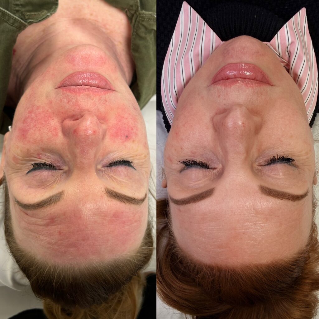 xlummeca After 1 treatment - D&M Treatments
